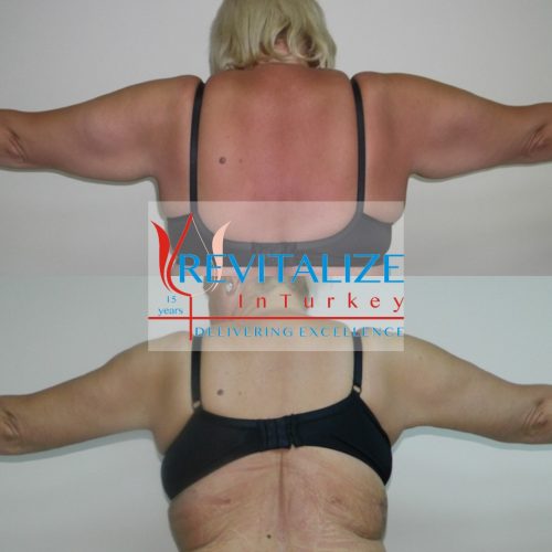 arm lift before after