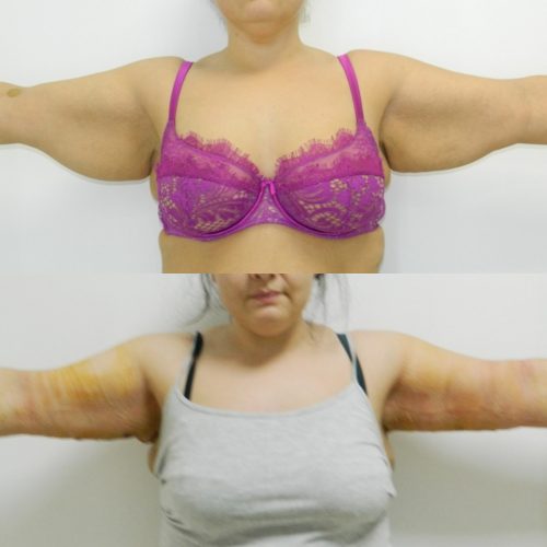 arm lift before after