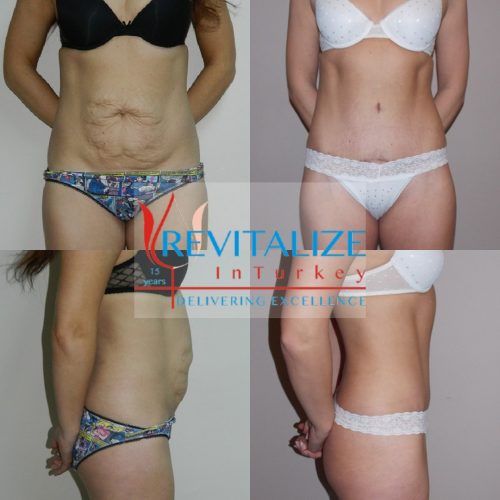 tummy tuck before &amp; after