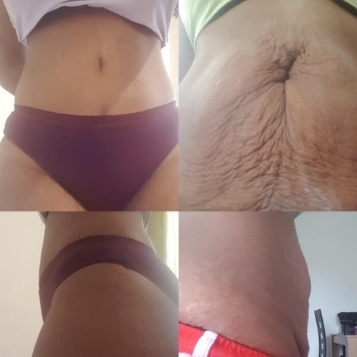 Tummy tuck comparison: 2 months after surgery on the left, before surgery on the right